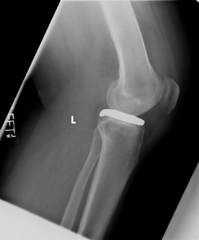 Orthoglide (Implant 618)
